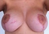 8 months after sugery