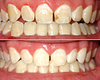 Teeth Whitening Before and After Photos