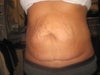 Before tummy tuck. Severe stretch marks.