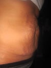 side view before tummy tuck. Saggy skin and severe stretch marks.