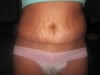 after tummy tuck. Extreme swelling on left side vs right side. scar higher up on left side.