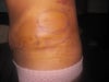 left side after tummy tuck. The inner circle was drawn at my PO appt around the hard and red area to make sure it didn't spread due to the fact the PA that I saw at my PO originally thought it was an infection. I saw the PS 2 days later at my re-check and he said it was not an infection but a bleed.