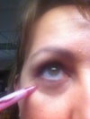 Right under eye buldge-hollow