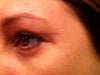 Left upper eye extending scar