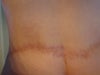 creation of a false buttocks cleft due to belt lipectomy, would like to correct.