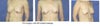 Breasts with 250cc implants placed in 2000. Note ptotis, left breast size d/t implant leakage and elevated IMF.