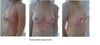 Implants replaced in March 2012 with 350cc (or so) silicone.