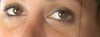 Under eye hollows at rest