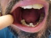 Missing both rearmost molars lower right side (30 and 31.. no 32 either, wisdom teeth removed)... Can I get braces to correct crooked teeth and overbite with these teeth missing?