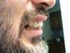Overbite that needs correction...