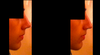 Left (3 weeks post-op), Right (ideal/decreased nasolabial angle)