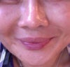 11 month after thread lift (3days before surgery (6/19/12): taken 6/16/12