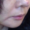 34 days after surgery on 7/22/12