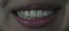 Crooked smile but I have a way to alter it on my own when I'm smiling for pictures