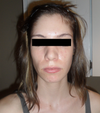 Very unhappy with the right side of my face (or left side in this photograph)