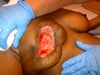 this is the wound after a week with wound vac ( july10)
