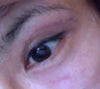 5 weeks and one day after surgery right eye