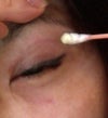 5 weeks and one day after surgery-right eye- New 10 mm high incision ( half outward is sitting there not folded)