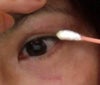 5 weeks and one day after surgery eye-My original 2mm high line is still working (folded).