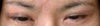 5 weeks and one day after surgery both eyes