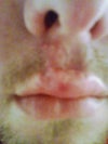 See lump/distortion on lip below the stitches