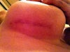 incision moving