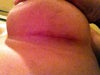 incision staying