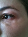 Left eye