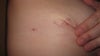 This is on my right breast at the end of my scar that is puffed up.