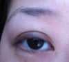 Extra fold on right eye