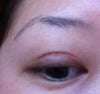 Indented scar on right eye