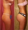 side view of Brazilian Butt Augmentation