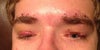 Both eyes open