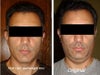 After/Beefore lipo & weight loss