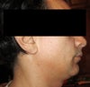 profile view, post lipo, weak jawline