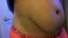 Side view with high scar