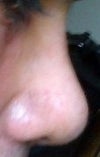 The day when my cast was taken out. right profile view