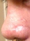 After 8 days of cast removal. Left profile view.  july 27 - 2012