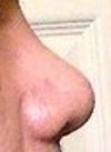 After 8 days of cast removal.Right profile view.  july 27 - 2012