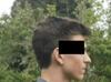 clearer view of droopy nasal tip and bulge under lower lip