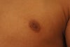 The left nipple. It is evident here that the tip has gone inward. This nipple is entirely flat against my chest and folds inward at certain bodily angles. My surgeon says the tip is going in due to swelling.