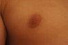 The right nipple. This one is still puffy enough to protrude from shirts. I am hoping that it could become flat and the tissue beneath is just swollen but in reality, I think there was just too much breast tissue left behind during the procedure.