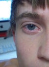 Bulging eyes
