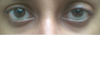 Asymmetrical eyelids