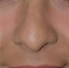 This was my nose before the Rhinoplasty...
