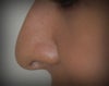 This is the profile view still before my Rhinoplasty...