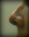 This is the profile view after my Rhinoplasty, one week after