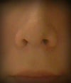 This is the front view after my surgery..