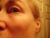 large soft lump on cheek