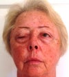 botox caused  paralysis 1